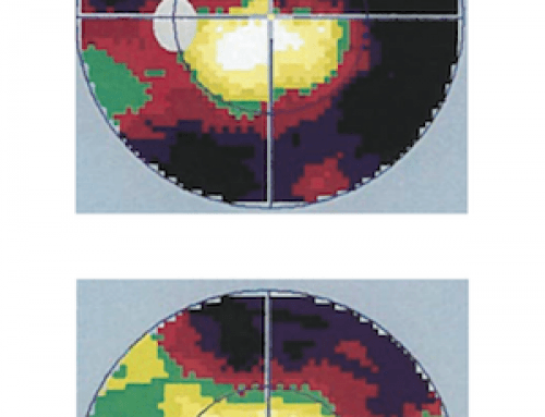 Recuperación del Campo Visual con Moléculas de Señalización Redox